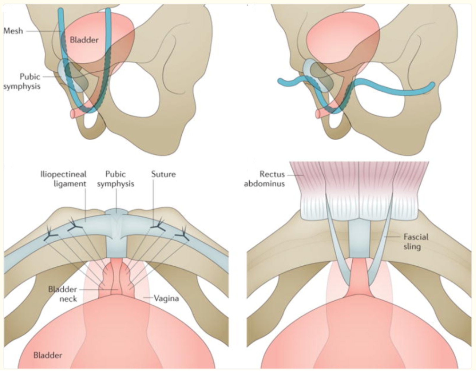 Kadınlarda İdrar Kaçırma