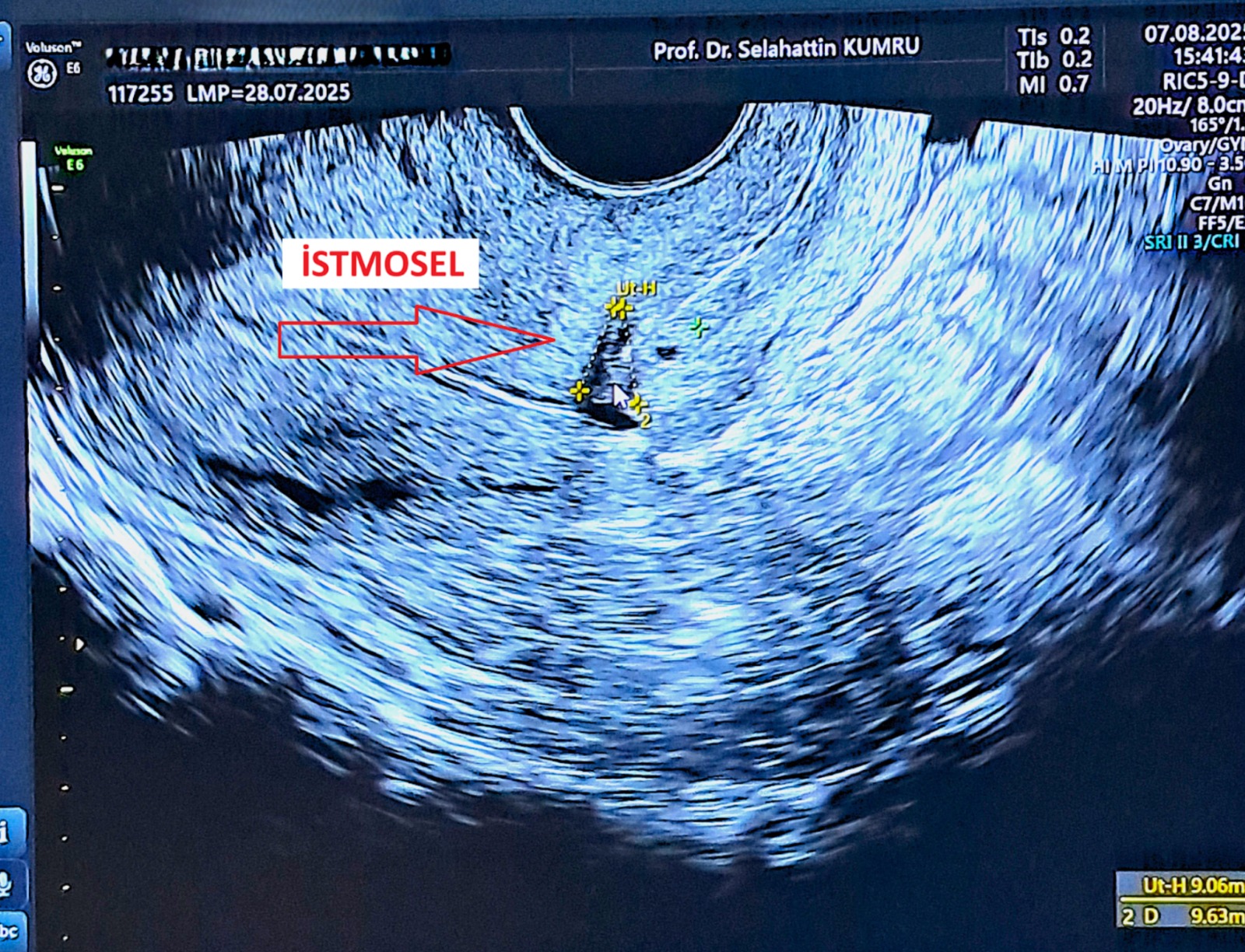 Kliniğimizde Tanı konulan İstmosel olgusunda ultrasonografik görünüm