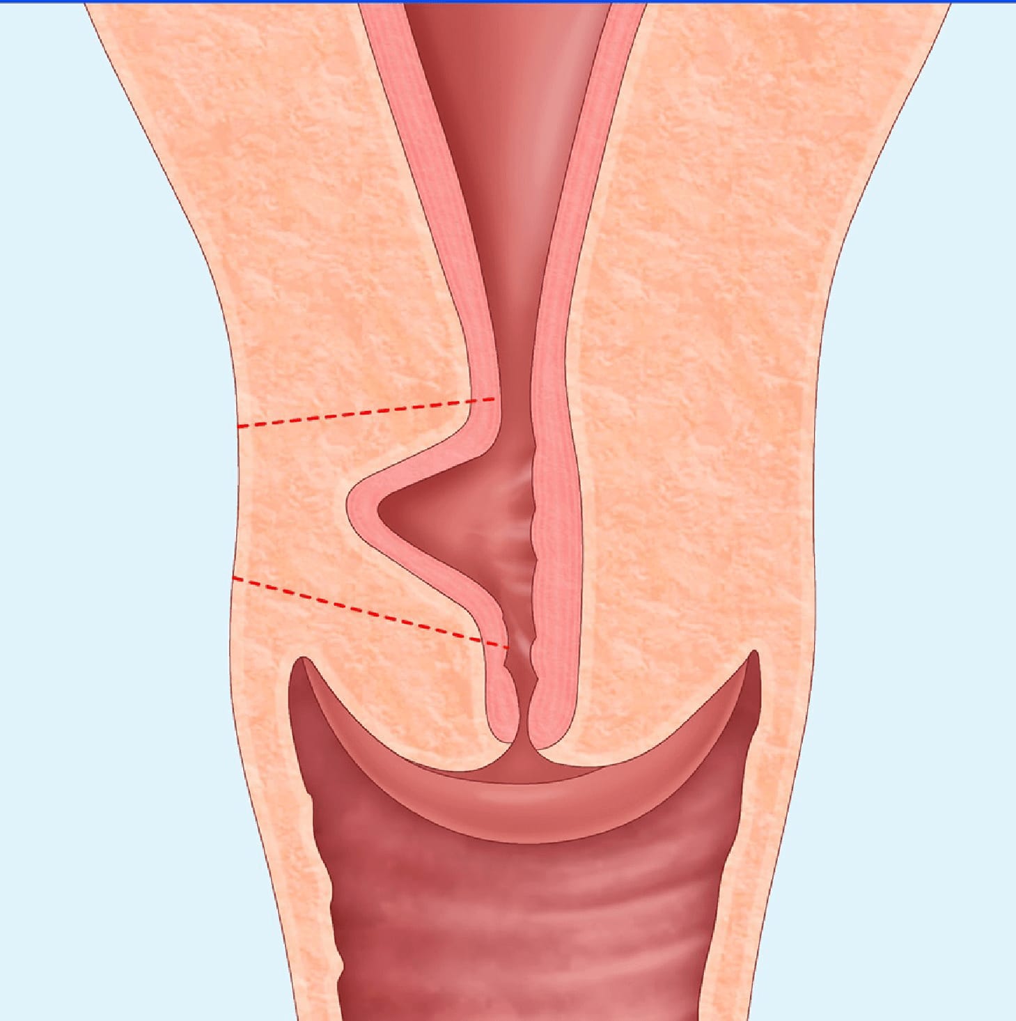 İstmosel (Sezaryen Skar Defekti)